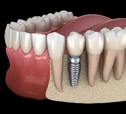 Implant Dentistry