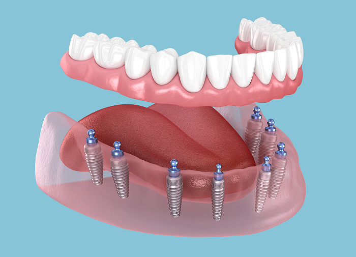 Implant-Supported Dentures