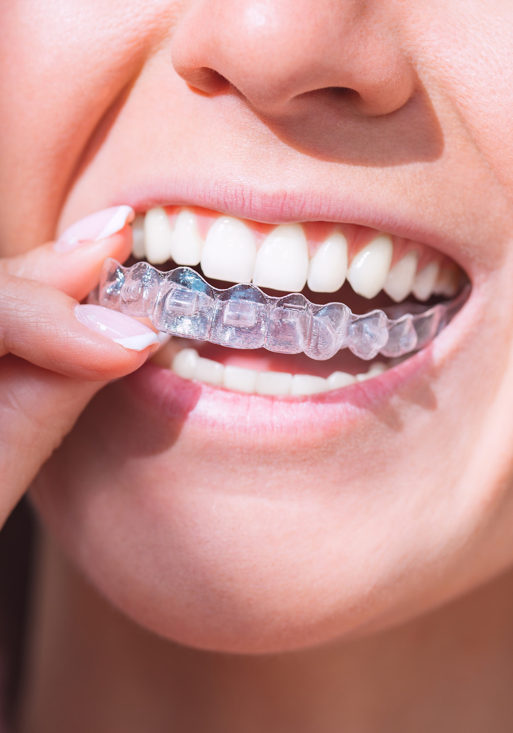 Clear Aligners Banner Image