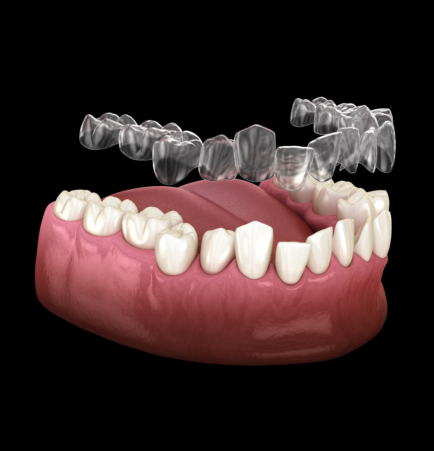 What Are Clear Aligners?