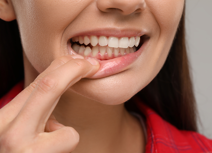 Periodontal Maintenance