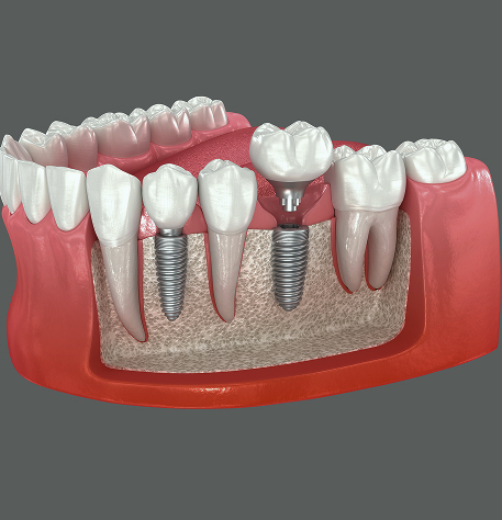 Single Tooth Dental Implants