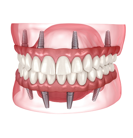 Implant-Supported Dentures