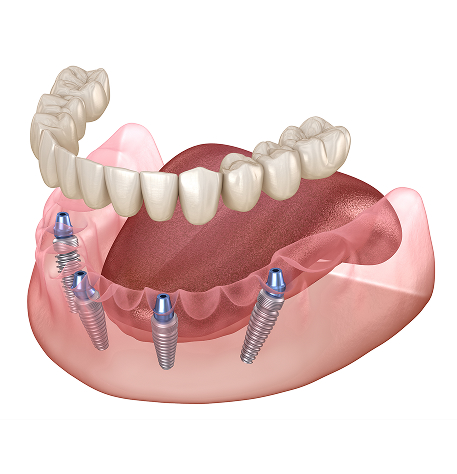 Full Arch Dental Implants