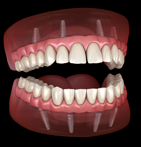 All-on-X Dental Implants