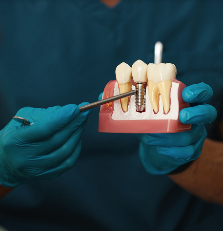 Same Day Dental Implants