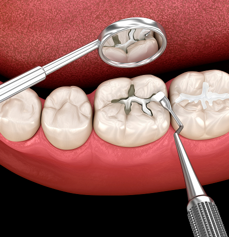 Tooth-Colored Fillings