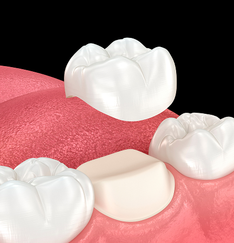 Dental Crowns