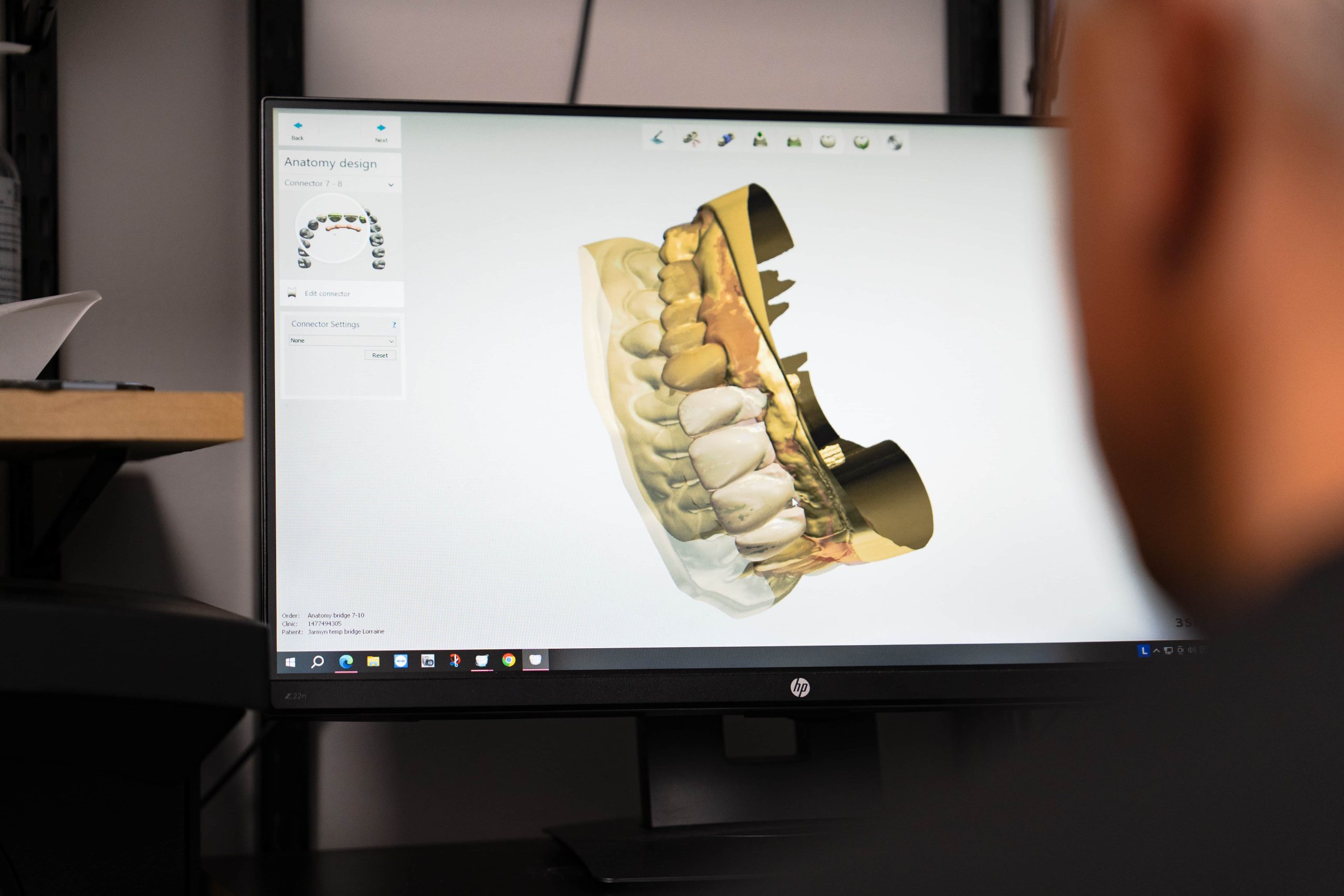 Fixed full arch implants replacing dentures