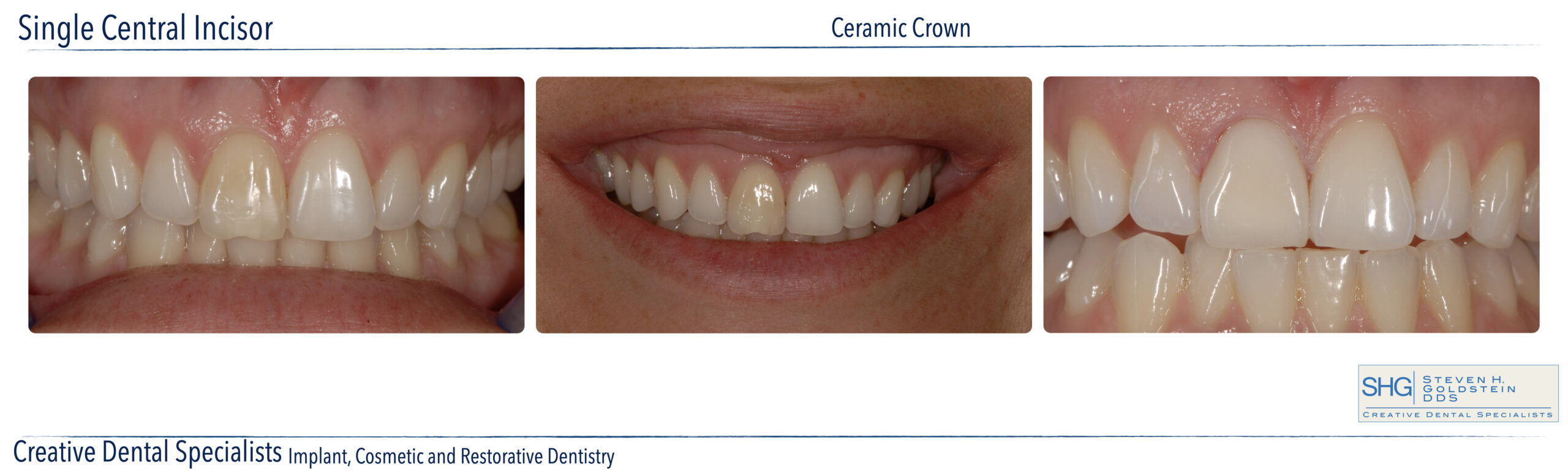 Ceramic Crowns