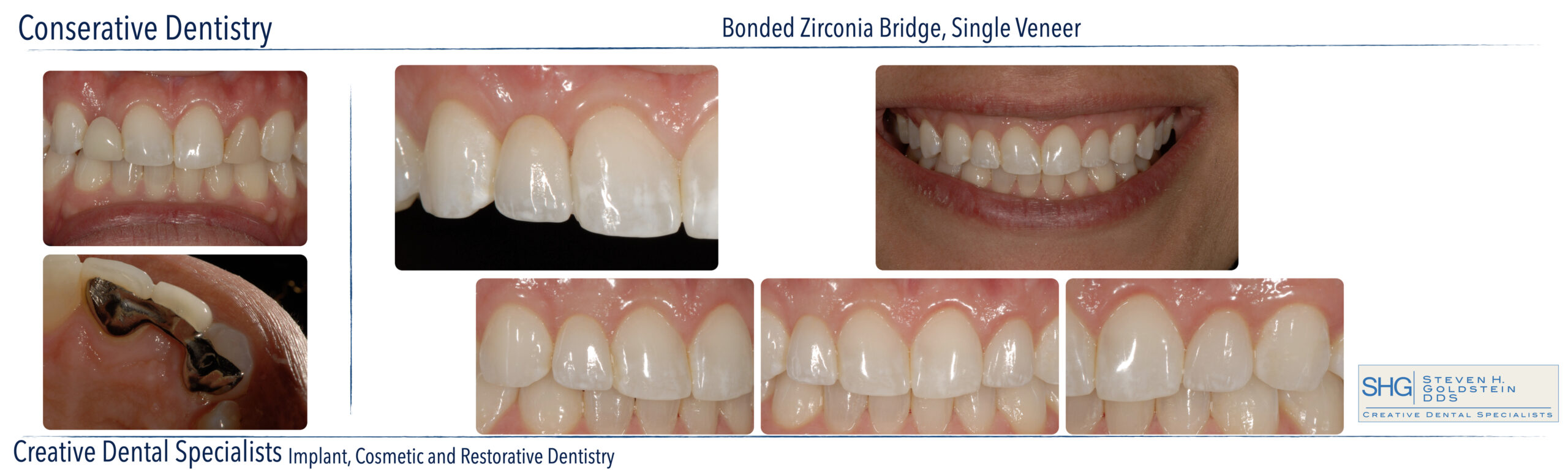 Ceramic Veneers