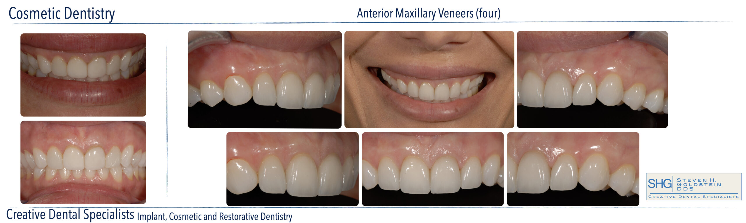 Ceramic Veneers