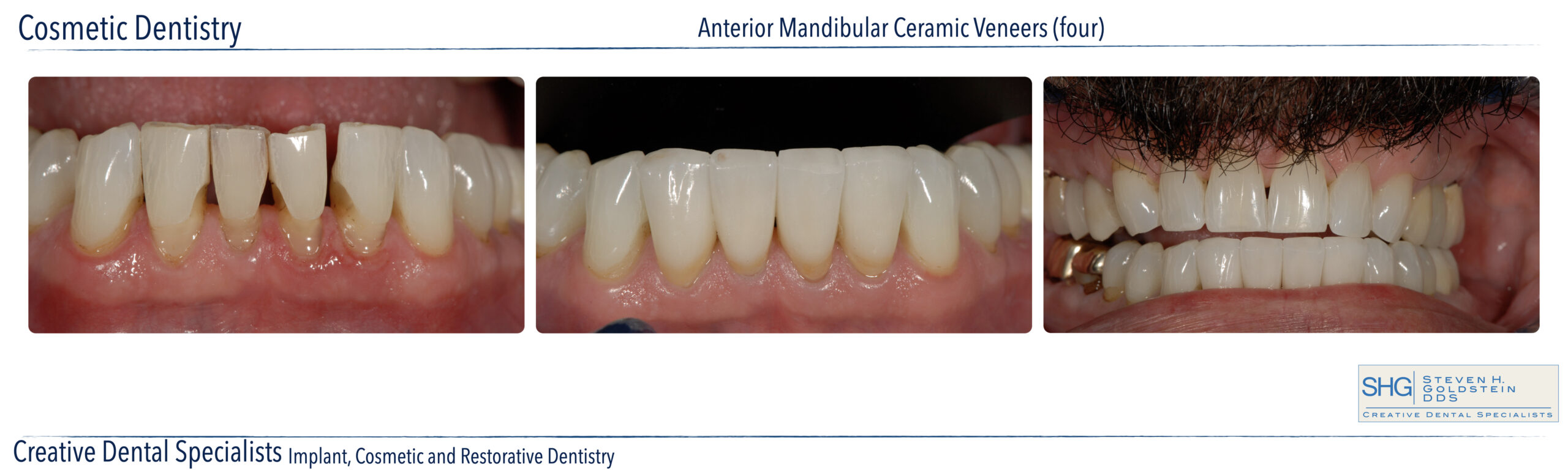 Ceramic Veneers