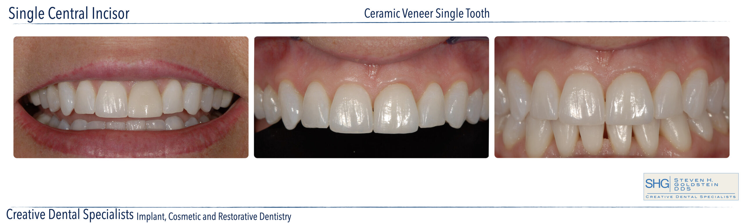 Ceramic Veneers