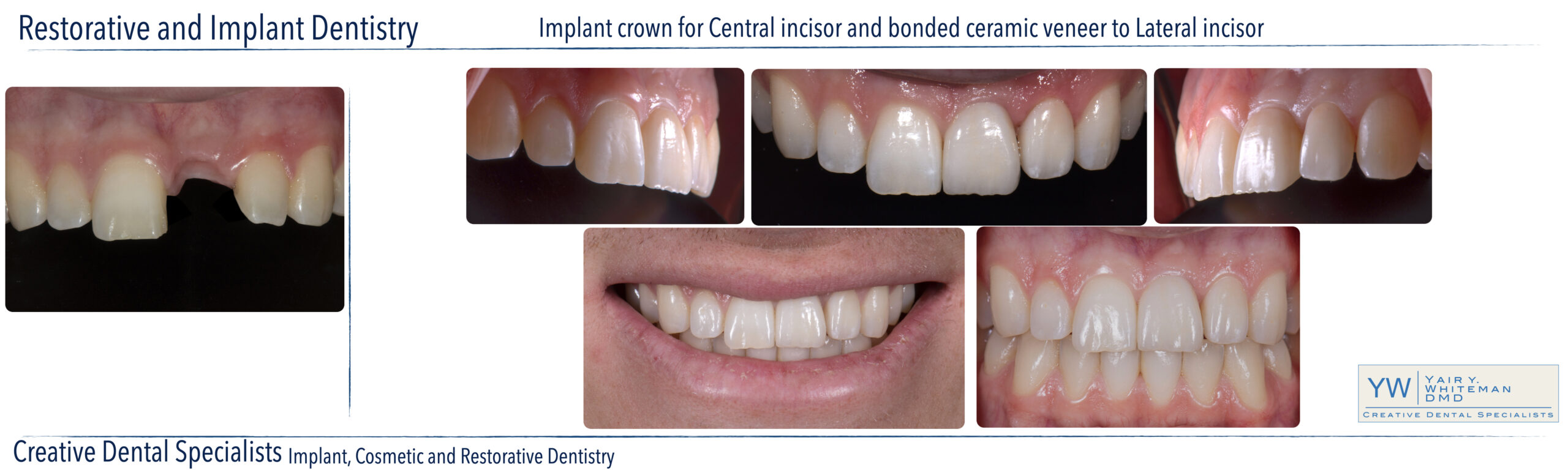 Ceramic Crowns