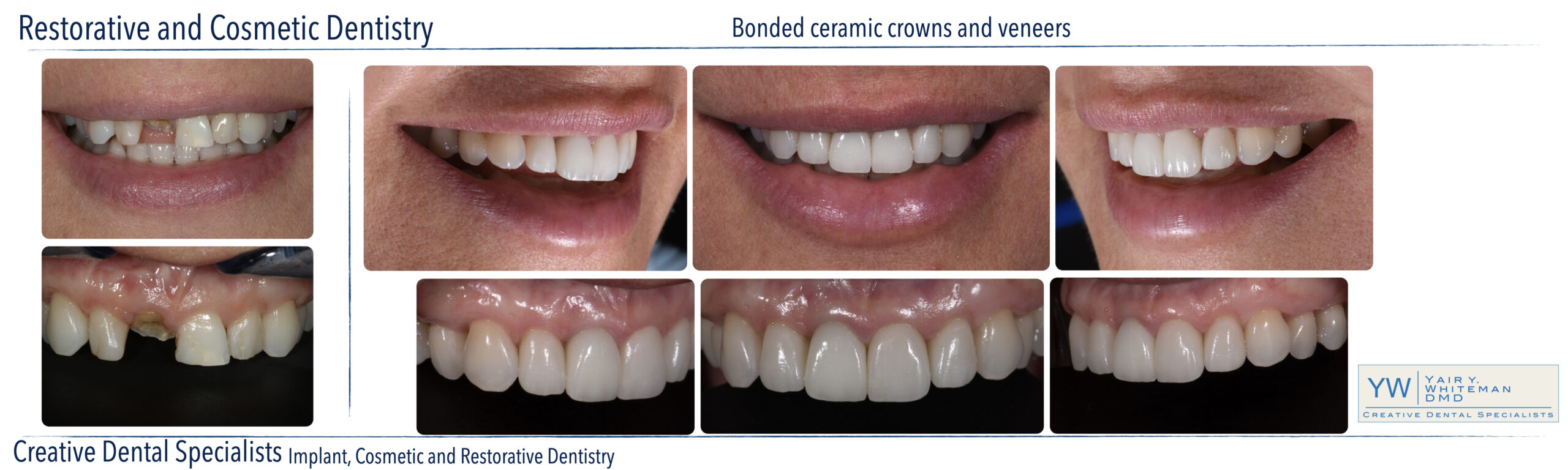 Ceramic Crowns