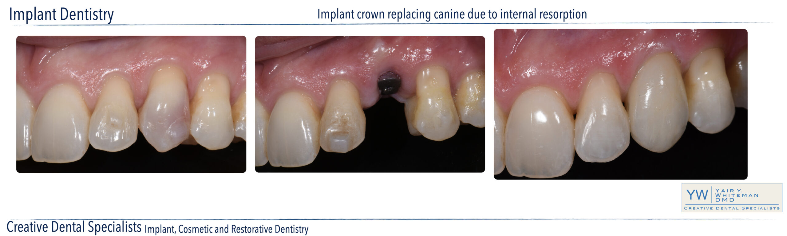 Implant Dentistry