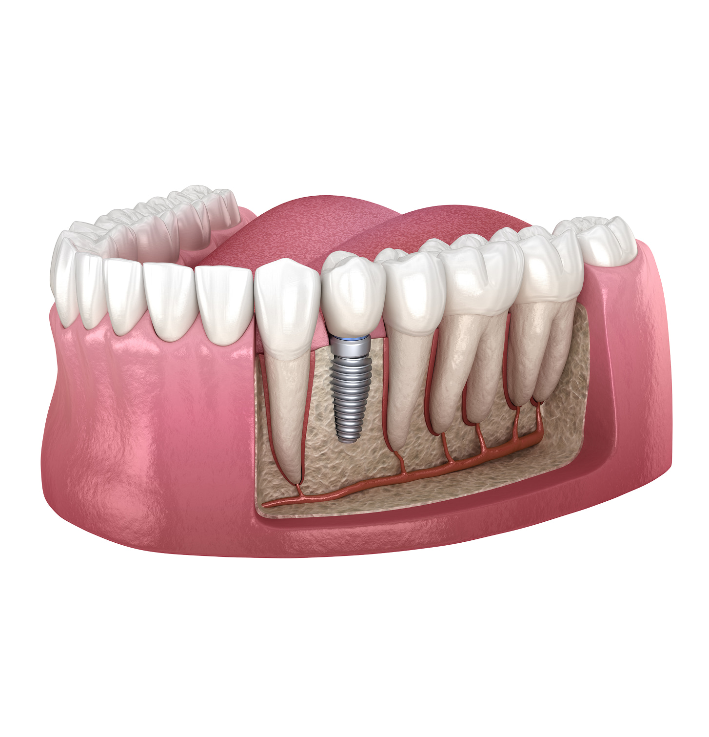 What Is Implant Dentistry?