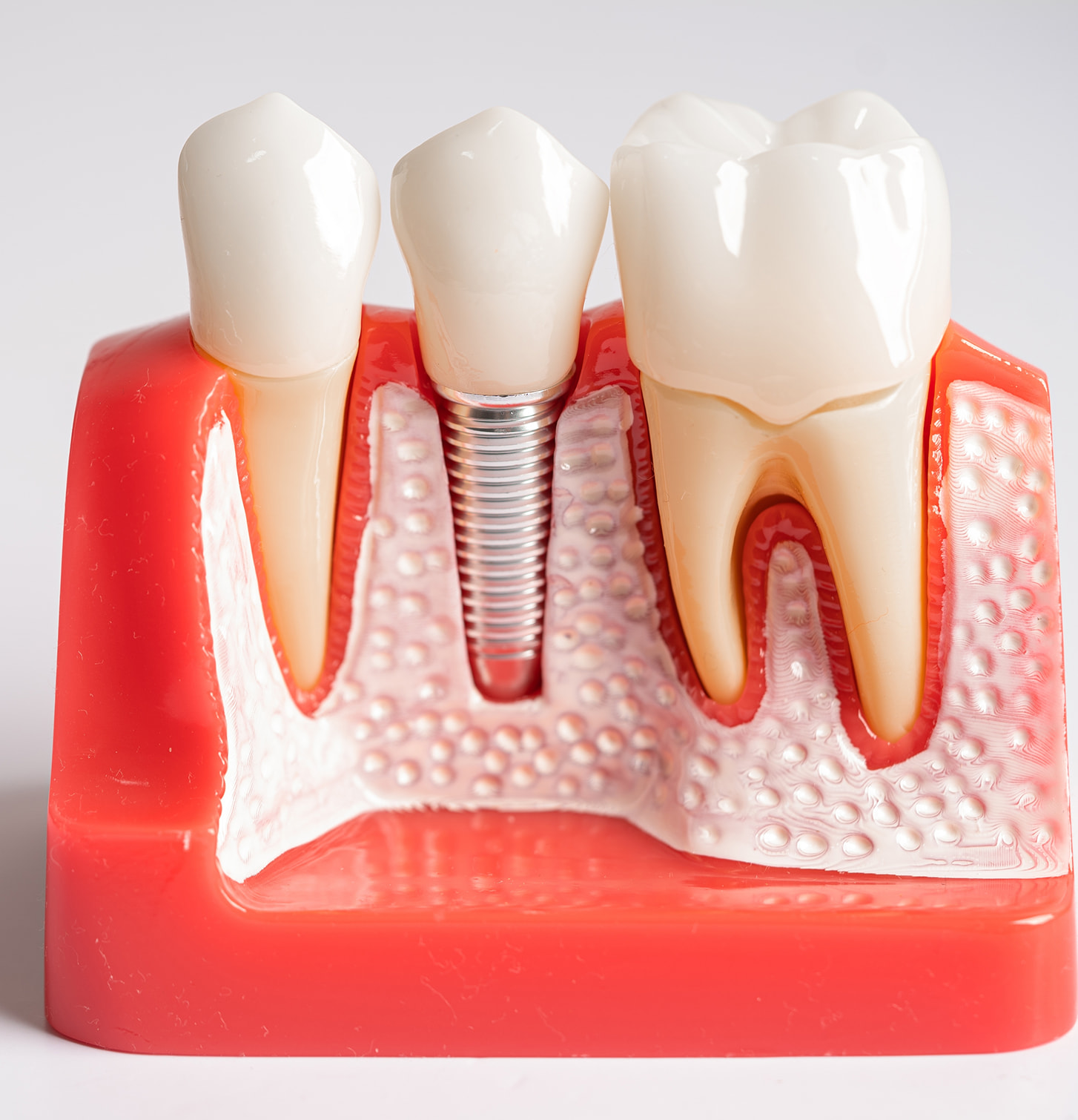 Concierge-Level Implant Care in Scottsdale