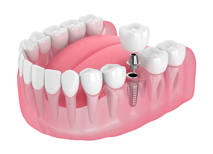 Single Tooth Implants