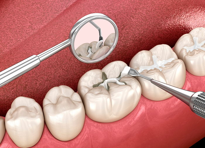 Dental Fillings