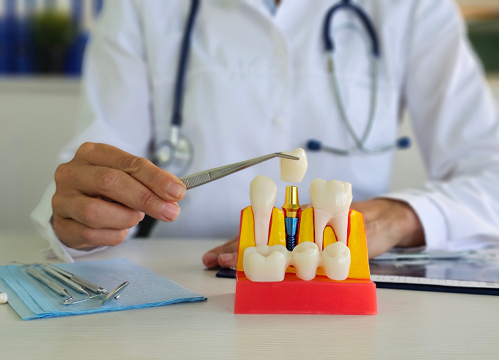 Tooth Replacement Solutions