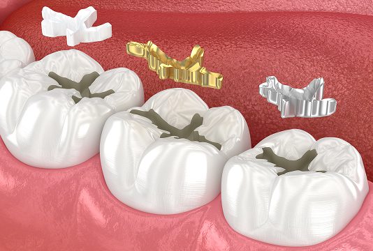 Dental Fillings