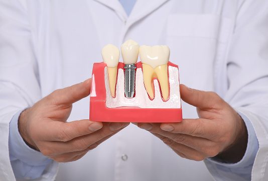 Dental Implants